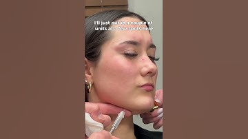 Nefertiti Neck Botox 💉🌟 #botox #facefixr #drkennethsanders #shreveportbossier