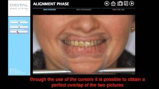 Digital Smile System (DSS) -  tutorial English