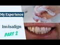 My Invisalign Experience Part 2 - Halfway