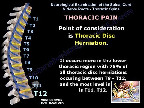 Video: Pinched Nerve In The Thoracic Region