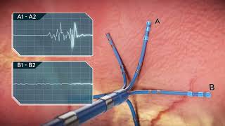 Cardiac Electrophysiology Systems | Trailer | Biomedical Engineers TV |