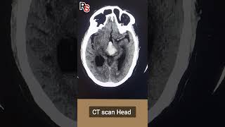 Bleed in Ganglio thalamic region #bleed #ctscan #radiology #brain