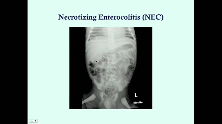 Newborn Gastrointestinal Disorders (Part 3) - CRASH! Medical Review Series