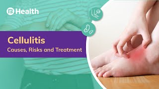 What is Cellulitis? | Causes, Symptoms, Diagnosis, and Treatment | Bajaj Finserv Health
