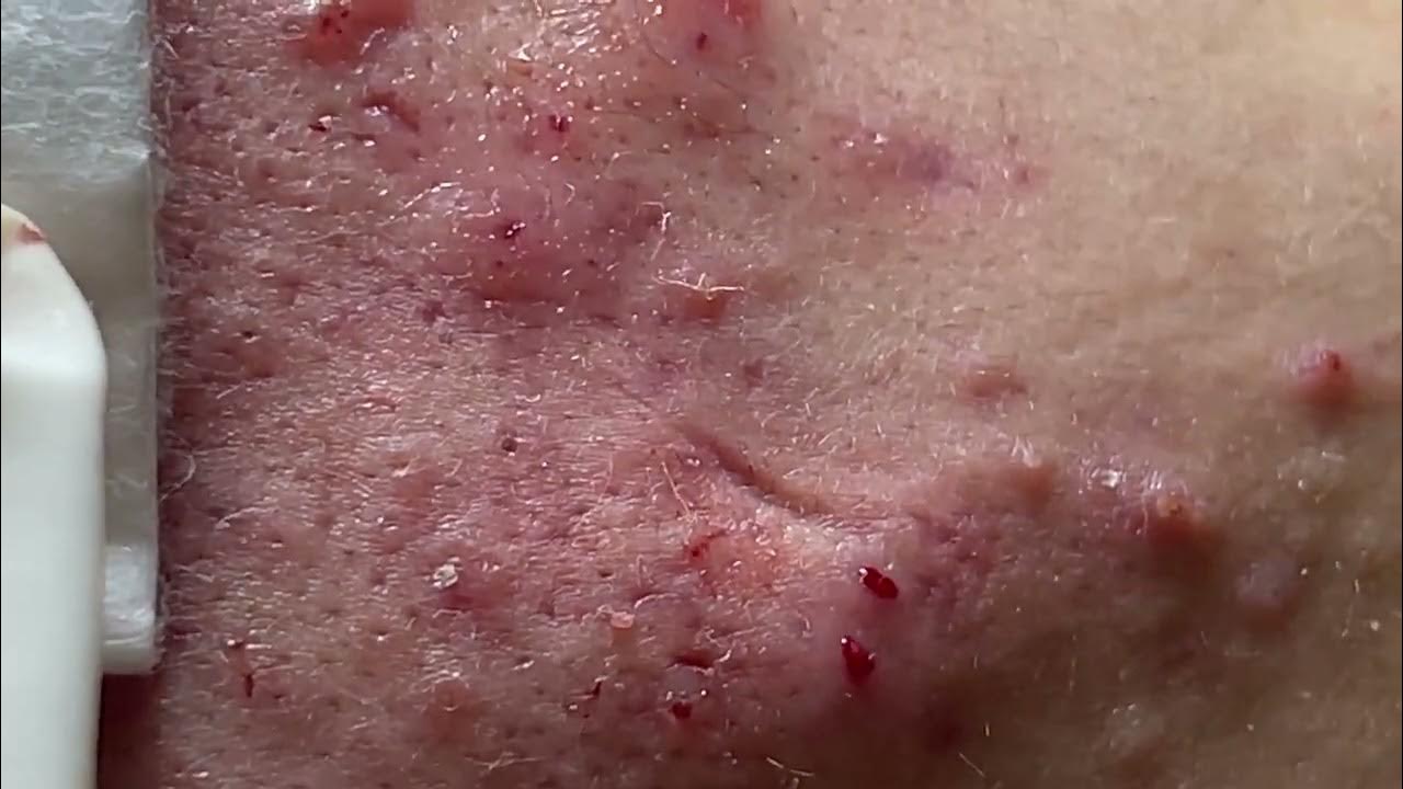 ACNE TREATMENT - Tri Mun Da Nang Mai Ngoc - YouTube