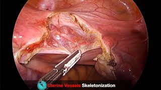 Total Laparoscopic Hysterectomy Uterine Vessel Skeletonization