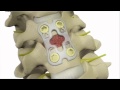 Anterior Cervical Discectomy and Fusion - DePuy Videos