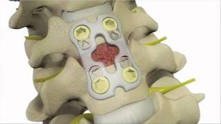 Anterior Cervical Discectomy and Fusion  DePuy Videos