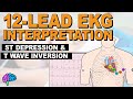 EKG and Ischemia Quiz