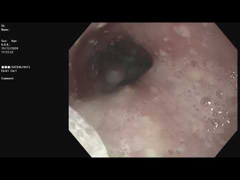 Video: La Dilatación Gástrica-Vólvulo