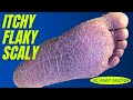 Itchy flaky scaly dry cracked athletes feet  part 2 of itchy itchy