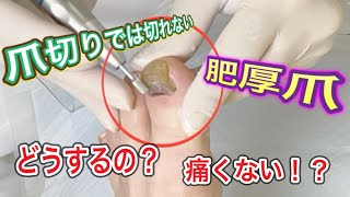 【肥厚爪】痛みのない肥厚爪ケア　ドクターネイル爪革命　横浜港北