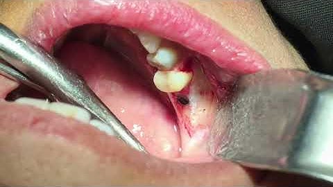 Guided bone regeneration with implant placement 2(full video)