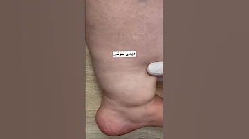 التخلص من احتباس السوائل والسموم في الجسم علاج فعال بشكل كتير كبير بوقت قصير جد ا تنحيف تخسيس 