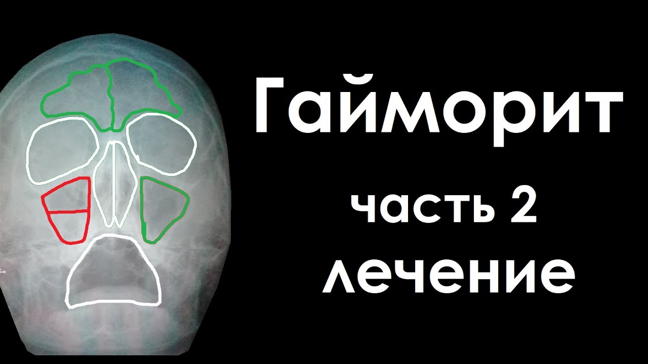 Гайморит - моя болезнь, лечение