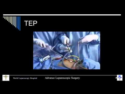 Master Class Of Laparoscopic Totally Extraperitoneal  TEP  Hernia Repair By Dr R K Mishra