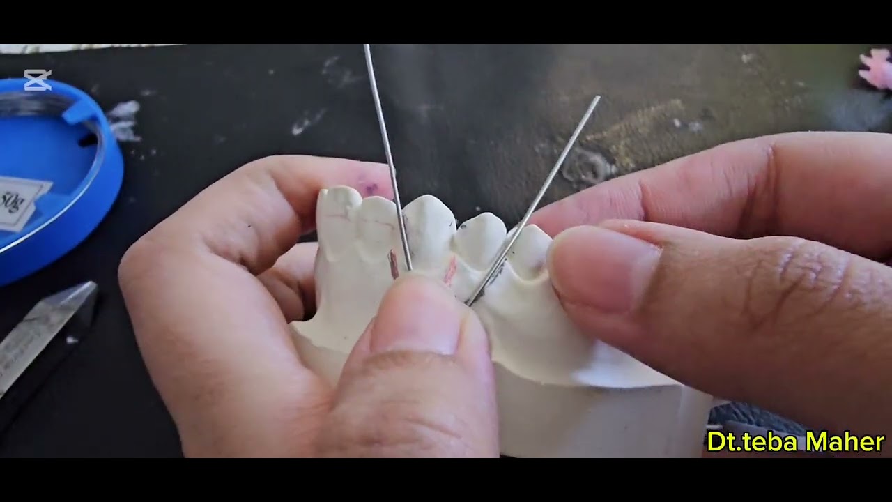 Simple buccal canine retractor 