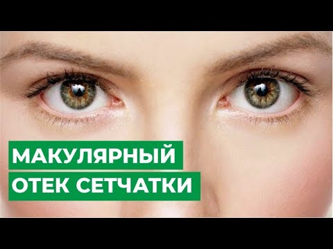 Лечение макулярного отека сетчатки.