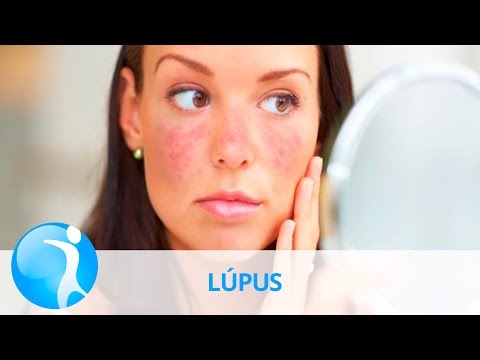 Vídeo: Lúpus Na Face - Causas, Sintomas, Diagnóstico E Tratamento De Lúpus Na Face