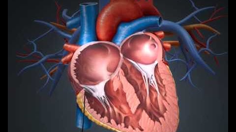 VSD device closure - Dr Nageswara Rao Koneti
