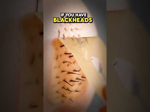 Get Rid Of Black Heads With An Egg Mask