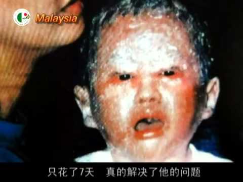 ICHTHYOSIS VULGARIS Testimonial Super Lutein & Izumio 寻常型鱼鳞病 识霸  活美水 见证  Call +6588763282