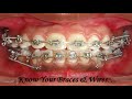 Know your braces  wires i how braces works smile correction best orthodontist in delhi dr ram mds