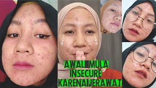 MY ACNE STORY | PART 1 | Perjuangan melawan jerawat ( ACNE FIGHTER )