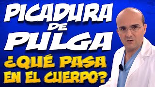PICADURA DE PULGA - ¿Qué pasa dentro del cuerpo de las personas que la padecen?