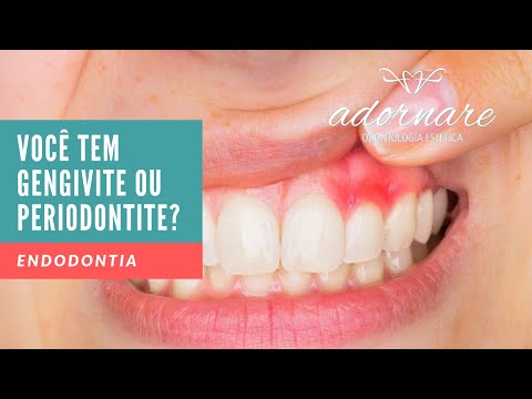 Você sofre de Gengivite ou Periodontite? Dicas de Saúde Bucal - Adornare Odonto