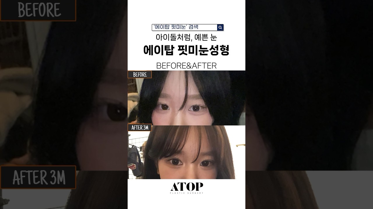 [A-TOP Plastic Surgery] Đánh giá phẫu thuật tạo hình mắt hai mí A-TOP