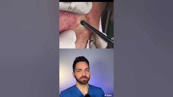 Doctor Explains CRAZY Blackhead | Doctorly #shorts