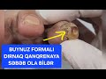 qanqrenanin baslangici diabetin fesadi neyropatiya dirnaqda qaralma yara merkezi trofiki xora cerrah