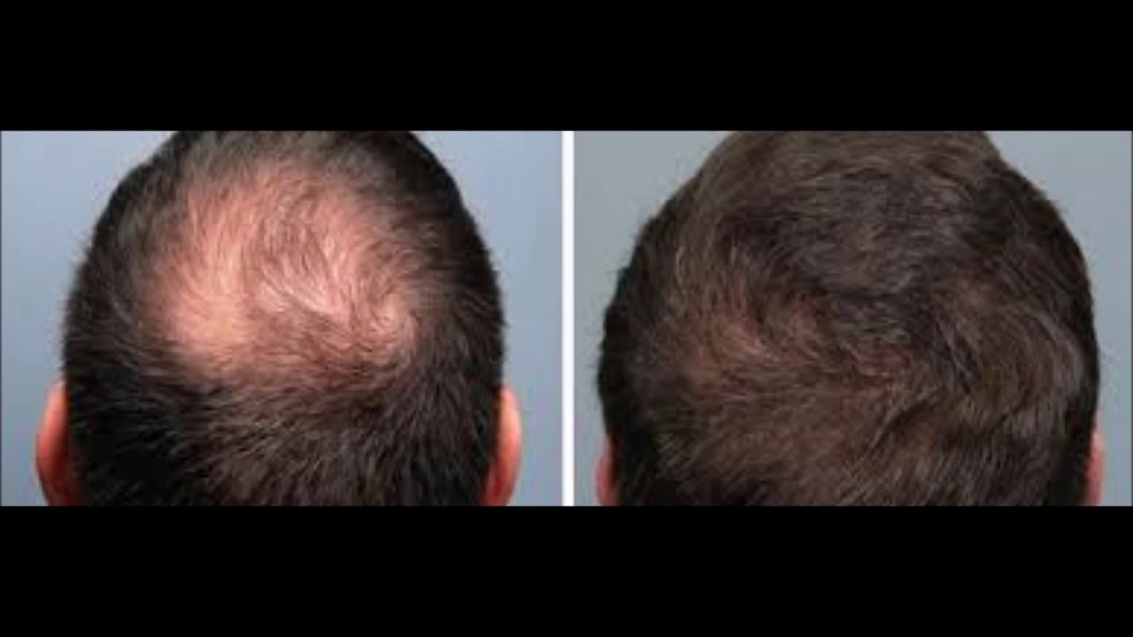 How To Regrow Loss Hair By Onion - How To Use Nizoral For Hair Loss -  YouTube