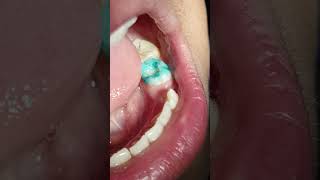 ПУЛЬПИТ ЛЕЧЕНИЕ И ПЛОМБА #shortsyoutube #dentist #stomatolog #КАРИЕС #пульпит #rekomendaci