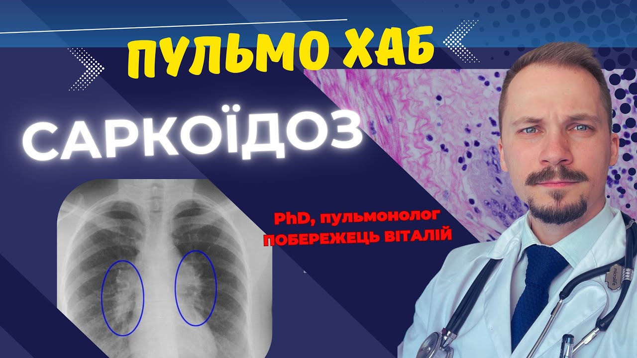 Саркоїдоз: що це за хвороба та як її лікують?