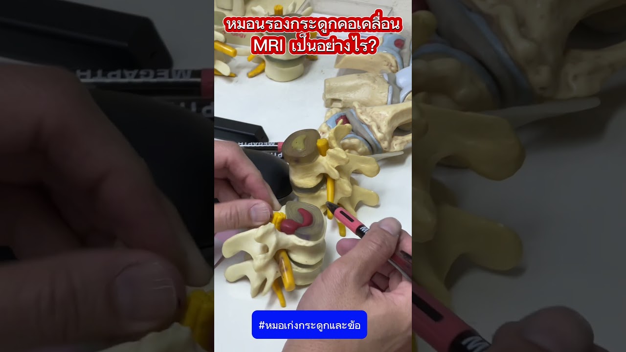 หมอนรองกระดูกคอเคลื่อน MRI เป็นอย่างไร?