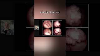 What do Bladder tumors look like