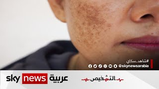 أحدث علاج لحب الشباب وطريقة إجرائه | #برنامج_التشخيص