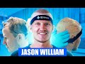 Jason from Leading the Escapade Gets a Hair Transplant – My Honest Experience!