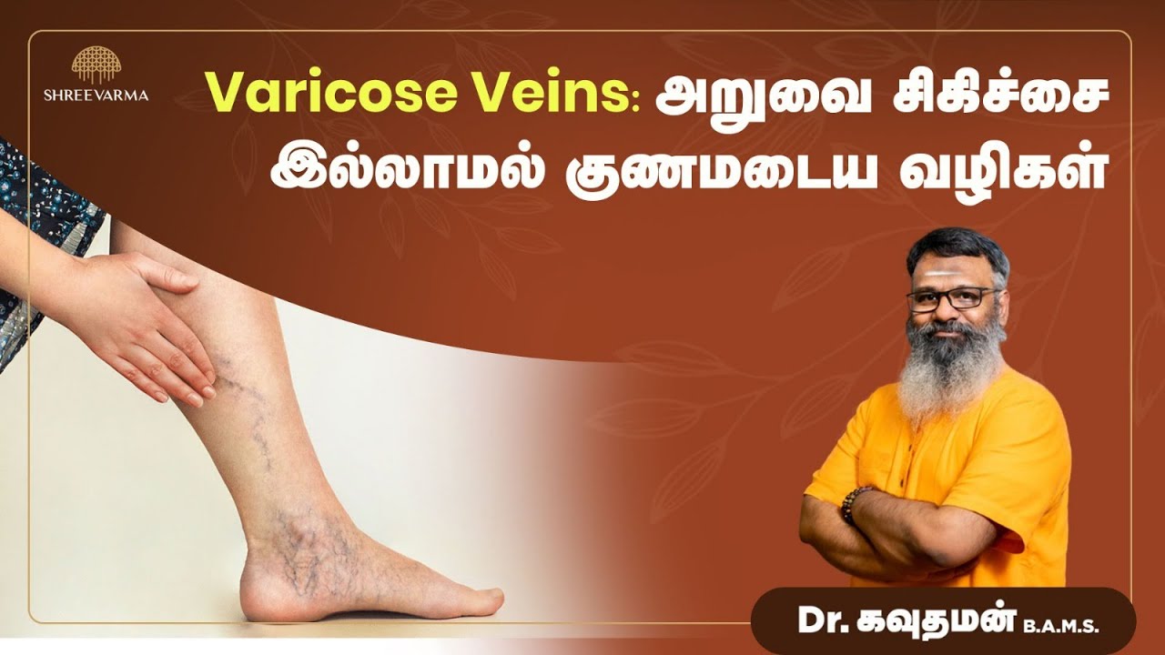 அதிக நேரம் நின்றால் வெரிகோஸ் வெயின்ஸ் வருமா?