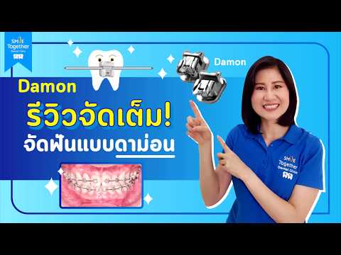 รีวิวจัดฟันดาม่อน ดียังไง+เหมาะกับเคสแบบไหน?