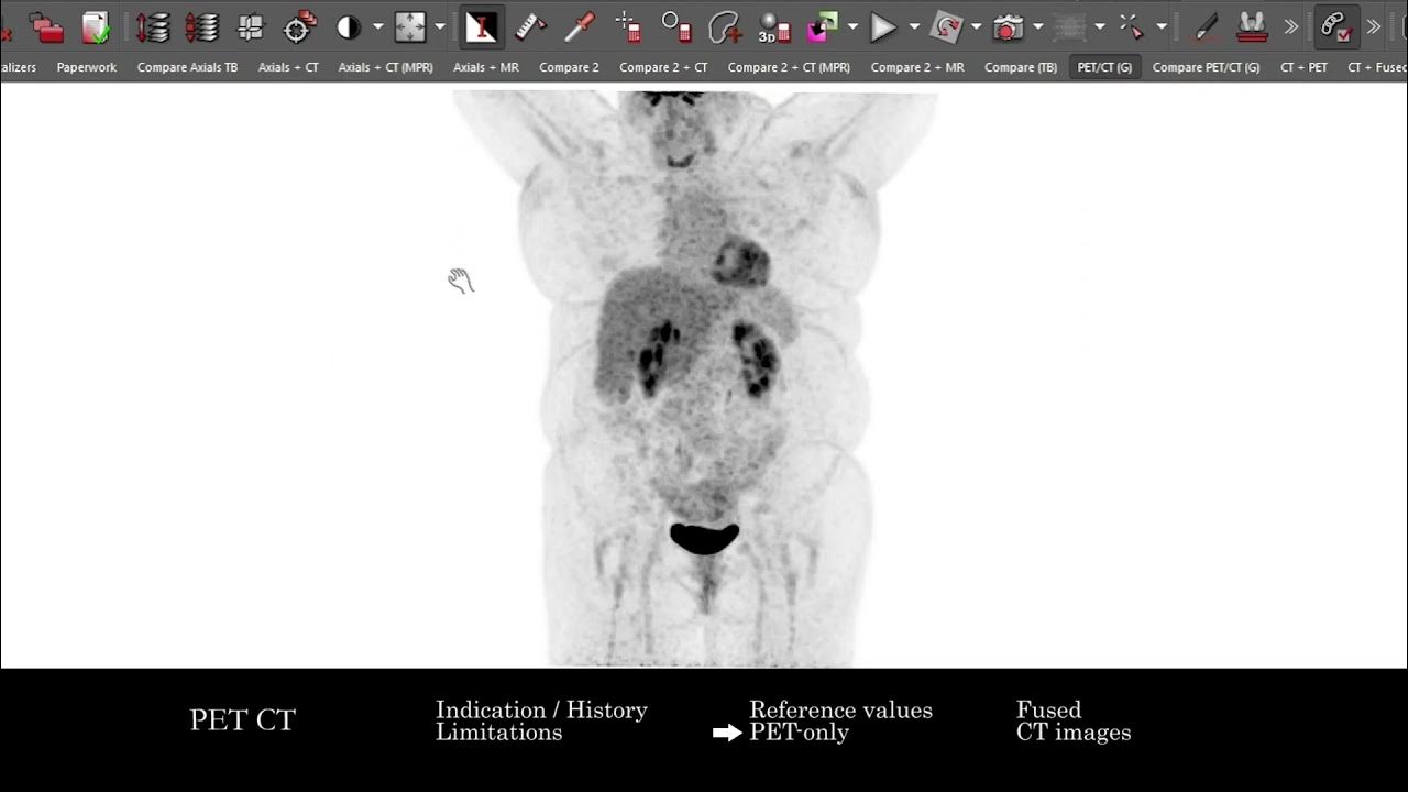 nm-pet-ct-search-pattern-youtube