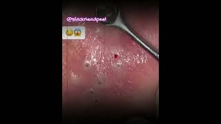 Relax Blackhead Removal 078  shorts  blackhead  acne  pimplesremoval  satisfying