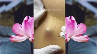 Big Blackhead ingrown hair removal.. Disgusting..