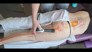 Effective Sciatica Treatment: Shockwave Therapy & Chiropractic Care | Dr. Steve Knighton