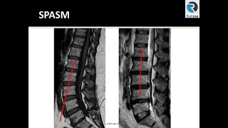 Lumbar Spine MRI Part 2: Spasm, Kyphosis