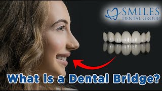 What is a Dental Bridge? How is it Made (2021)?