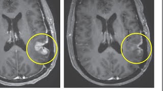 Early clinical trial results show dramatic progress against glioblastoma tumors