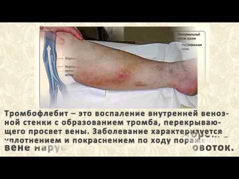 Склеивание вен на ногах отзывы
